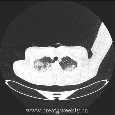 图片[1]-病例67 | 每周呼吸-每周呼吸