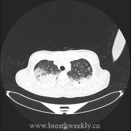 图片[4]-病例67 | 每周呼吸-每周呼吸