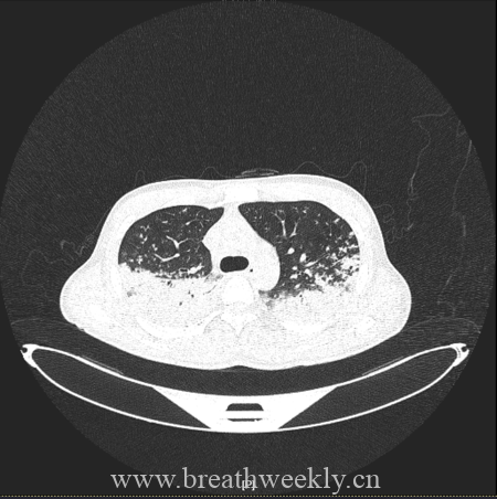 图片[7]-病例67 | 每周呼吸-每周呼吸