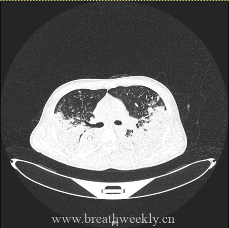 图片[11]-病例67 | 每周呼吸-每周呼吸