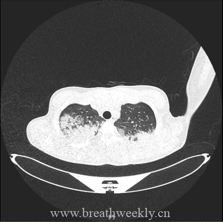 图片[3]-病例67 | 每周呼吸-每周呼吸