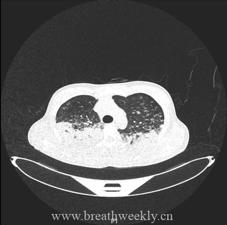 图片[6]-病例67 | 每周呼吸-每周呼吸