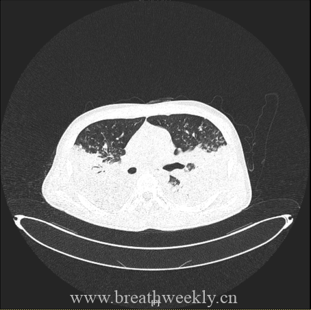 图片[13]-病例67 | 每周呼吸-每周呼吸