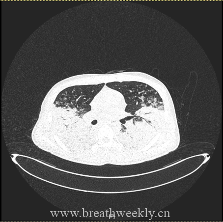 图片[14]-病例67 | 每周呼吸-每周呼吸