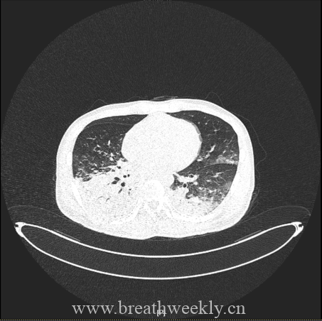 图片[20]-病例67 | 每周呼吸-每周呼吸