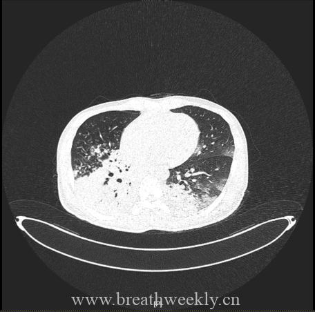 图片[21]-病例67 | 每周呼吸-每周呼吸