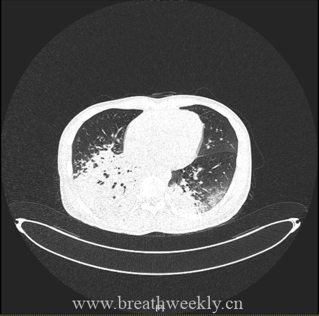 图片[22]-病例67 | 每周呼吸-每周呼吸