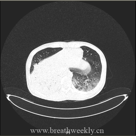 图片[25]-病例67 | 每周呼吸-每周呼吸