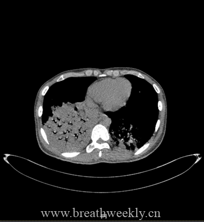 图片[42]-病例67 | 每周呼吸-每周呼吸