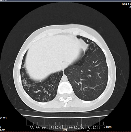 图片[10]-病例69 | 每周呼吸-每周呼吸
