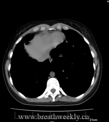 图片[16]-病例69 | 每周呼吸-每周呼吸