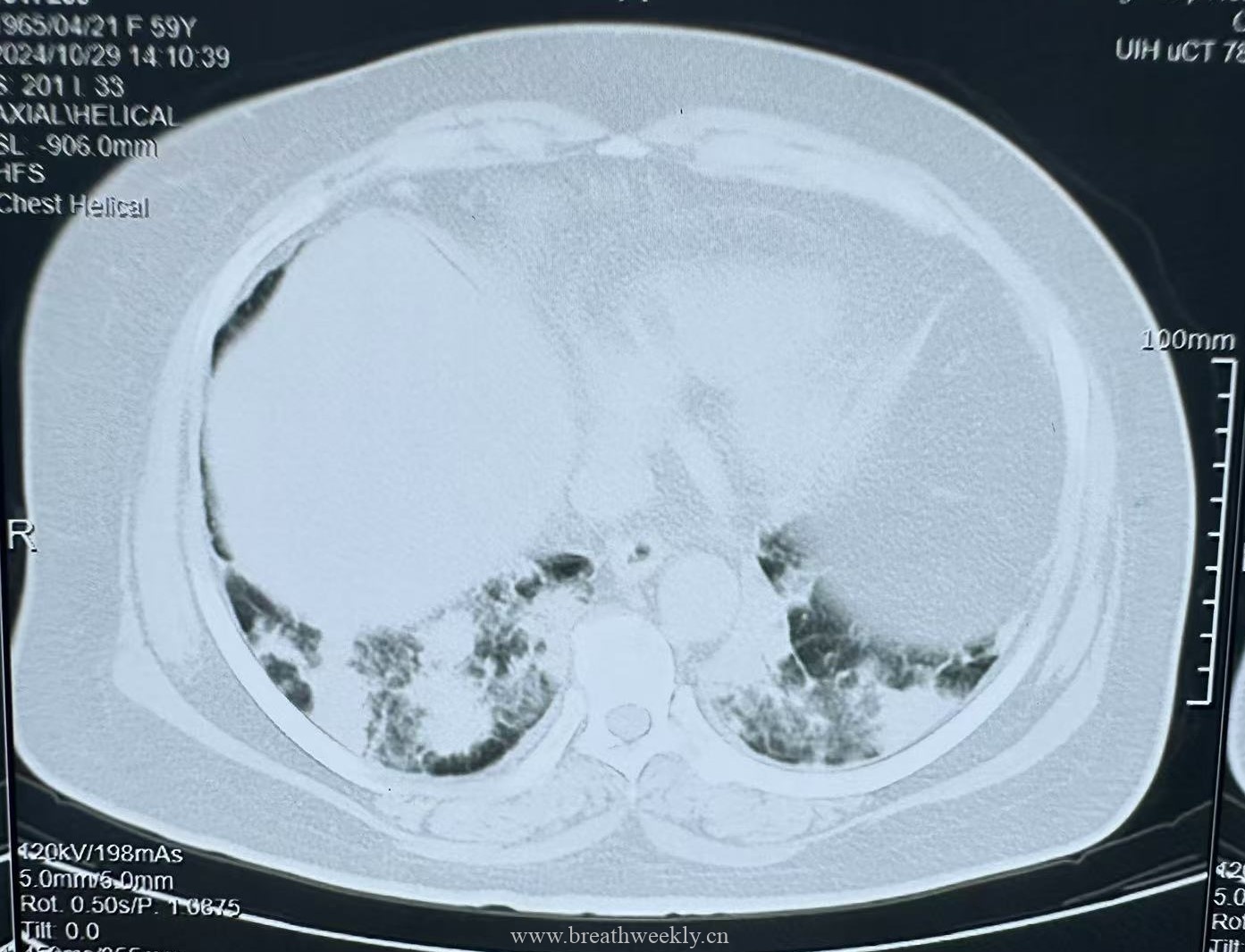 图片[10]-病例70 | 每周呼吸-每周呼吸